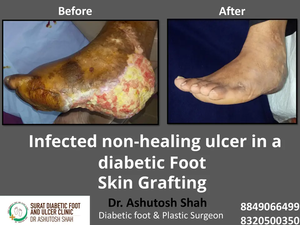 Debridement and Skin Grafting.pptx-10.webp